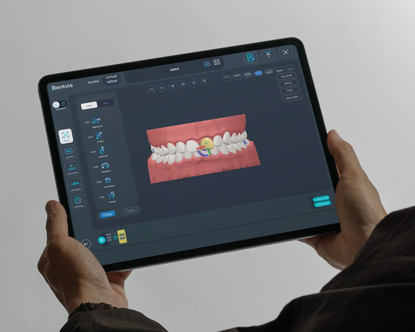 DentVIS on iPad — Virtual Setup editing of a dental arch