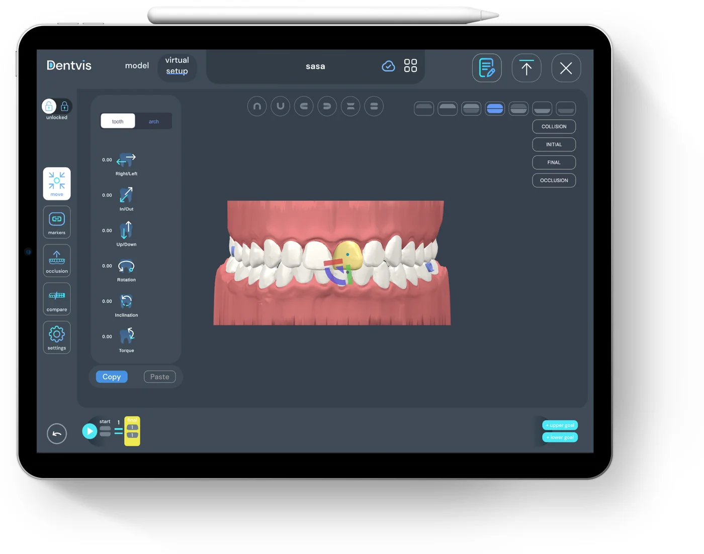Virtual Setup editing of a single tooth in DentVIS on iPad